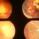 Blastomycosis Blastomycosis